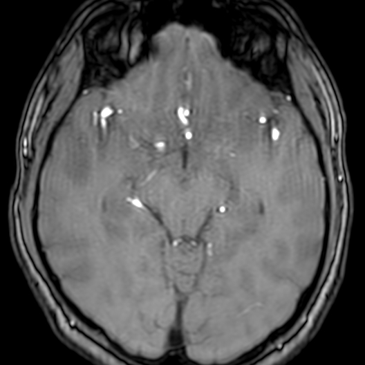 Cerebral arteriovenous malformation at posterior body of corpus callosum (Radiopaedia 74111-84925 Axial MRA 88).jpg