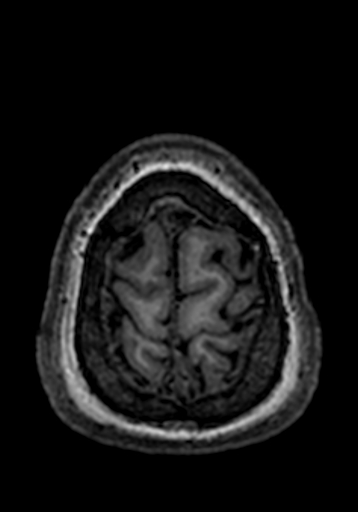 Cerebral arteriovenous malformation at posterior body of corpus callosum (Radiopaedia 74111-84925 Axial T1 10).jpg