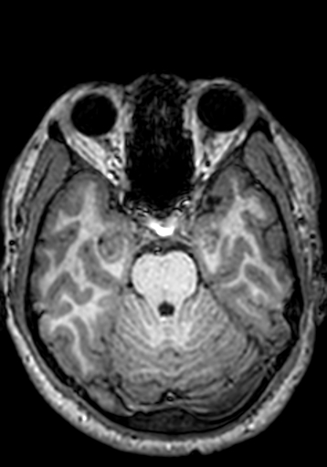 Cerebral arteriovenous malformation at posterior body of corpus callosum (Radiopaedia 74111-84925 Axial T1 210).jpg