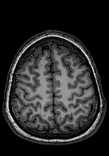 File:Cerebral arteriovenous malformation at posterior body of corpus callosum (Radiopaedia 74111-84925 Axial T1 48).jpg
