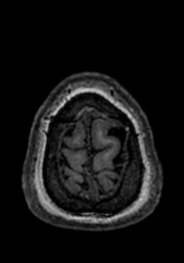 Cerebral arteriovenous malformation at posterior body of corpus callosum (Radiopaedia 74111-84925 Axial T1 5).jpg
