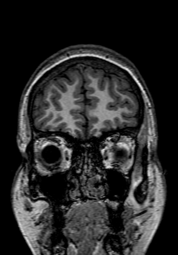 Cerebral arteriovenous malformation at posterior body of corpus callosum (Radiopaedia 74111-84925 Coronal T1 28).jpg