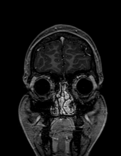 Cerebral arteriovenous malformation at posterior body of corpus callosum (Radiopaedia 74111-84925 K 32).jpg