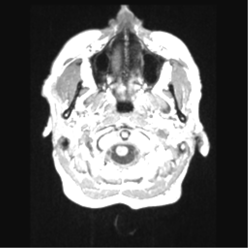 Cerebral arteriovenous malformation with hemorrhage (Radiopaedia 34422-35737 Axial T1 4).png