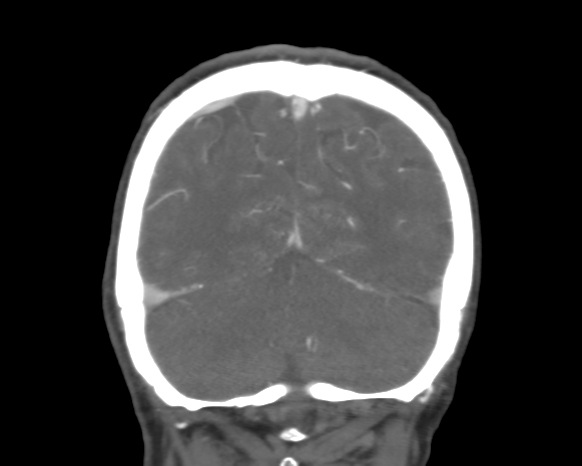Cerebral arteriovenous malformation with lobar hemorrhage (Radiopaedia 44725-48511 A 47).png