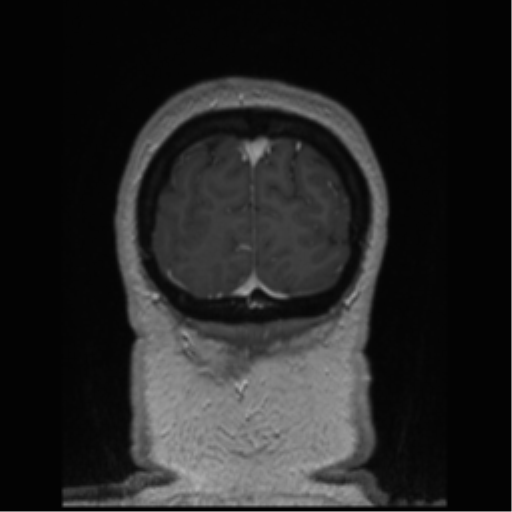 Cerebral cavernoma and development venous anomaly (Radiopaedia 37603-39482 Coronal T1 C+ 10).png