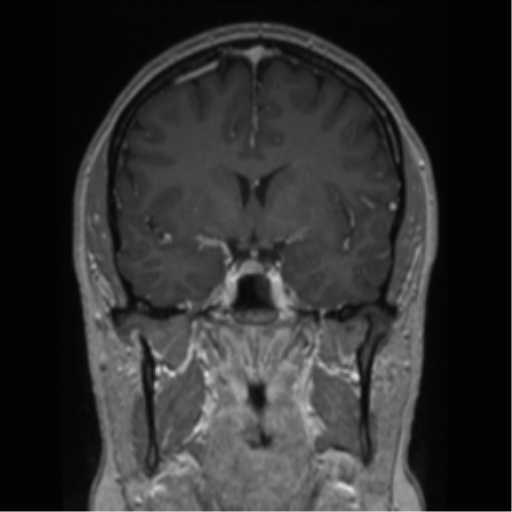 Cerebral cavernoma and development venous anomaly (Radiopaedia 37603-39482 Coronal T1 C+ 57).png