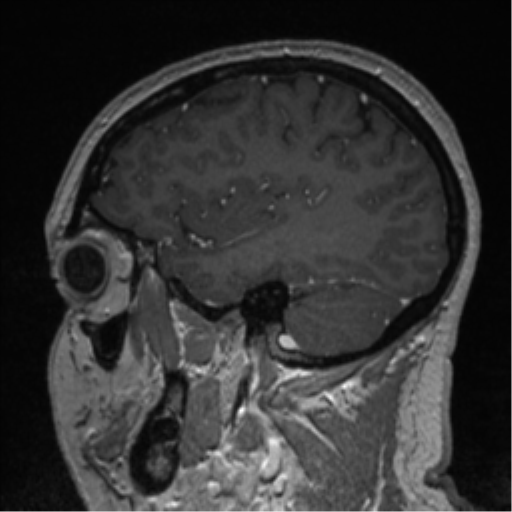 Cerebral cavernoma and development venous anomaly (Radiopaedia 37603-39482 Sagittal T1 C+ 27).png