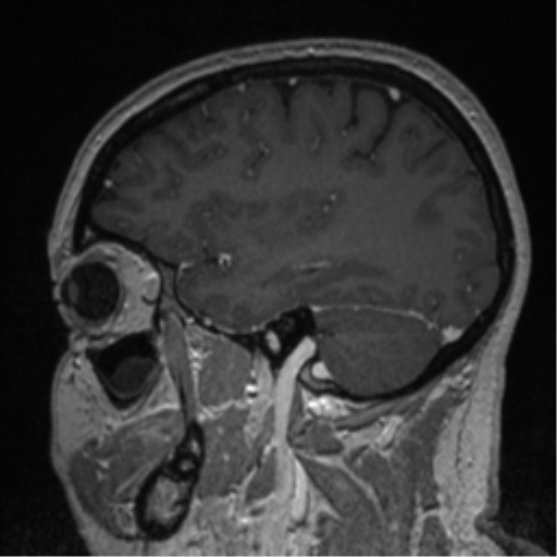 File:Cerebral cavernoma and development venous anomaly (Radiopaedia 37603-39482 Sagittal T1 C+ 68).png