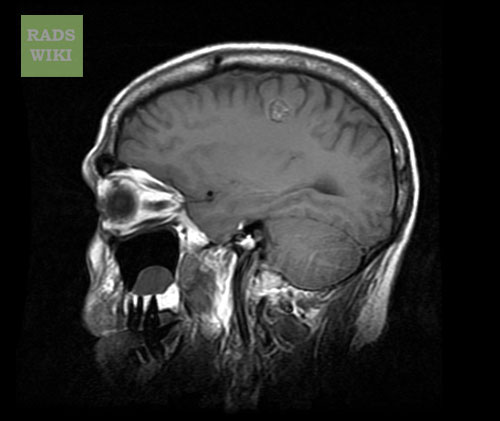 File:Cerebral cavernous malformation (Radiopaedia 11284-11648 Sagittal 1).jpg