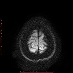 File:Cerebral cavernous malformation (Radiopaedia 26177-26306 Axial DWI 20).jpg