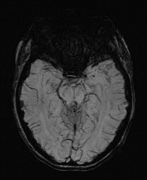 Cerebral cavernous venous malformation (Radiopaedia 70008-80021 Axial SWI 27).jpg
