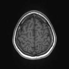 Cerebral cavernous venous malformation (Radiopaedia 70008-80021 Axial T1 76).jpg