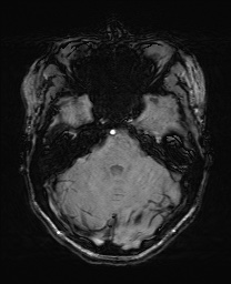 Cerebral cavernous venous malformation (Radiopaedia 70008-80021 I 20).jpg