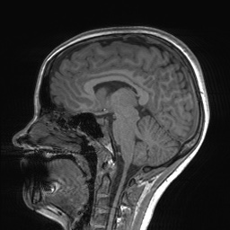 File:Cerebral cavernous venous malformation (Radiopaedia 70008-80021 Sagittal T1 40).jpg