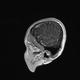 File:Cerebral cavernous venous malformation (Radiopaedia 70008-80021 Sagittal T1 C+ 66).jpg
