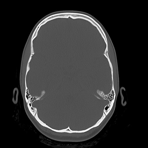 Cerebral cavernous venous malformation (Radiopaedia 70008-80022 Axial bone window 16).jpg