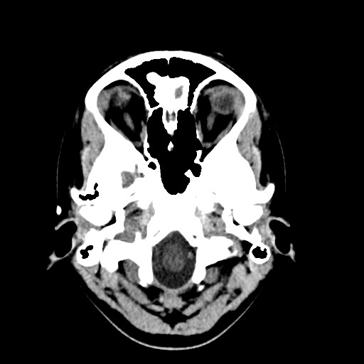File:Cerebral cavernous venous malformation (Radiopaedia 70008-80022 Axial non-contrast 4).jpg
