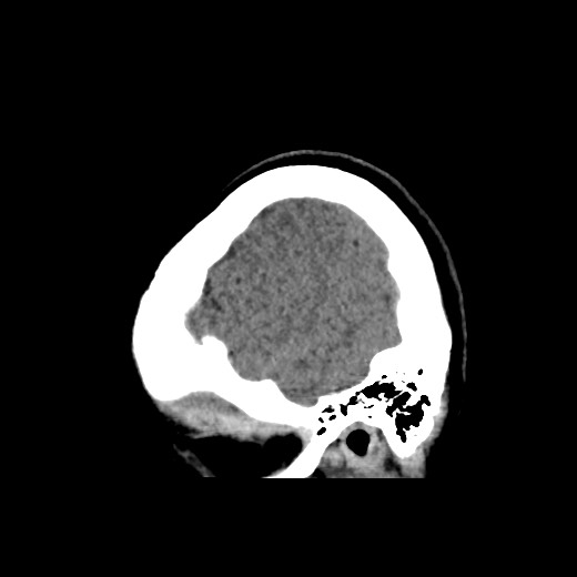 File:Cerebral cavernous venous malformation (Radiopaedia 70008-80022 C 6).jpg