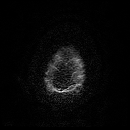 File:Cerebral cavernous venous malformation (Zabramski type II) (Radiopaedia 85511-101198 Axial DWI 98).jpg