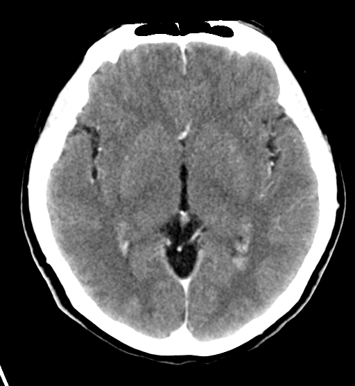 File:Cerebral cavernous venous malformations (Radiopaedia 48117-52945 Axial C+ delayed 17).png
