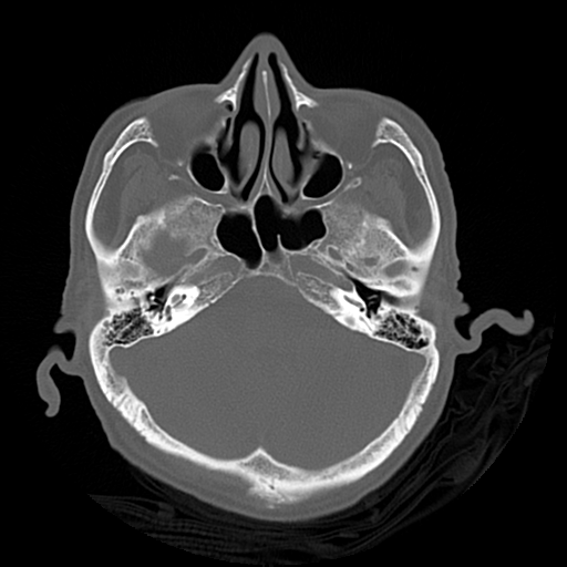 Cerebral contusions, subarachnoid hemorrhage and subdural hygromas (Radiopaedia 55399-61827 Axial bone window 13).png