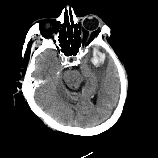 File:Cerebral contusions, subarachnoid hemorrhage and subdural hygromas (Radiopaedia 55399-61830 Axial non-contrast 12).png