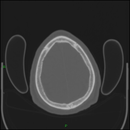 Cerebral contusions (Radiopaedia 33868-35039 Axial bone window 191).jpg