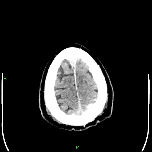 Cerebral contusions (Radiopaedia 33868-35039 Axial non-contrast 200).jpg
