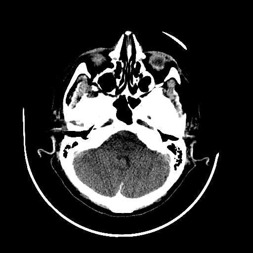 File:Cerebral edema (evolution in time) (Radiopaedia 19418-19439 non-contrast 22).jpg