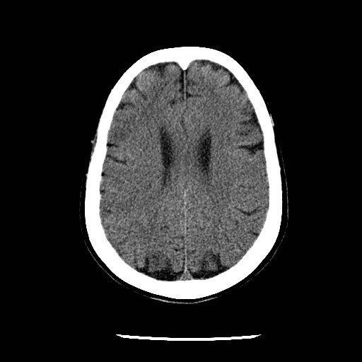 File:Cerebral edema (evolution in time) (Radiopaedia 19418-19441 non-contrast 66).jpg