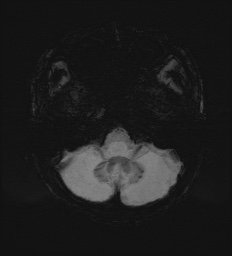 Cerebral embolic infarcts (embolic shower) (Radiopaedia 72391-82921 Axial SWI 13).jpg
