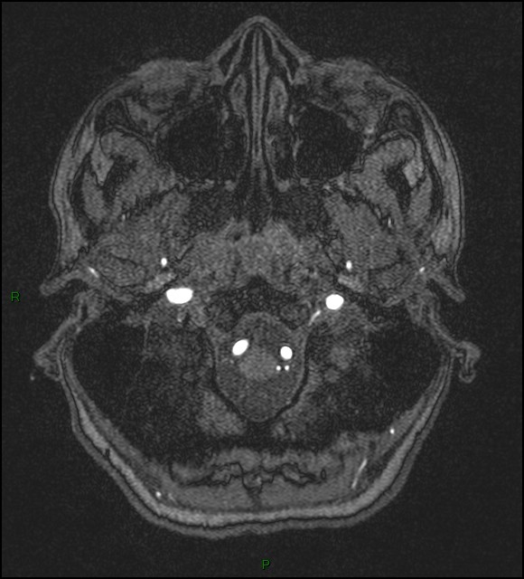 Cerebral fat embolism (Radiopaedia 35022-36525 Axial TOF 13).jpg