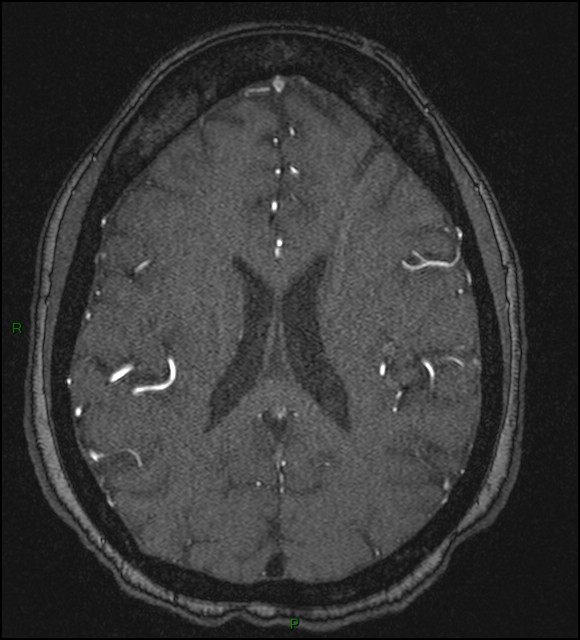Cerebral fat embolism (Radiopaedia 35022-36525 Axial TOF 130).jpg