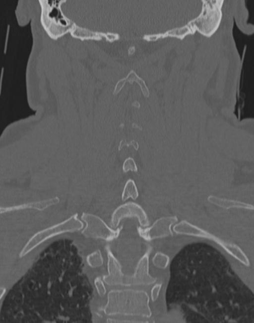 Cerebral hemorrhagic contusions and cervical spine fractures (Radiopaedia 32865-33841 Coronal bone window 51).jpg