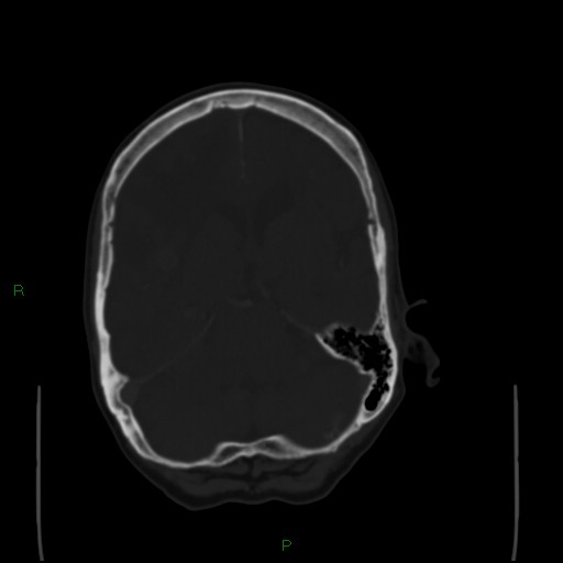 File:Cerebral metastases - breast primary (Radiopaedia 77653-89857 Axial bone window 45).jpg