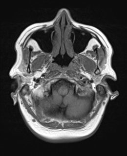 File:Cerebral metastases mimicking abscesses (Radiopaedia 45841-50131 Axial T1 4).png