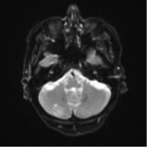 Cerebral metastasis (Radiopaedia 46744-51248 Axial DWI 6).png