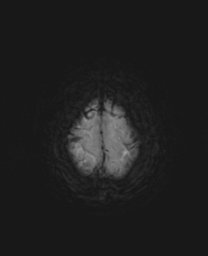 File:Cerebral metastasis (Radiopaedia 46744-51248 Axial SWI 26).png