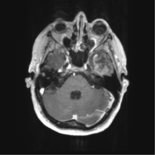 Cerebral metastasis mimicking glioblastoma (Radiopaedia 69155-78937 Axial T1 C+ 14).png