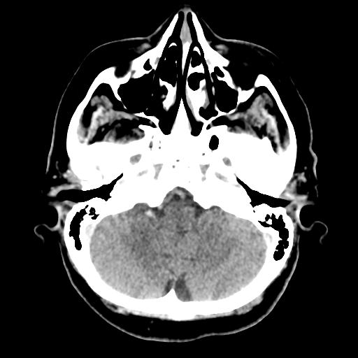 Cerebral metastasis to basal ganglia (Radiopaedia 81568-95412 Axial C+ delayed 15).png