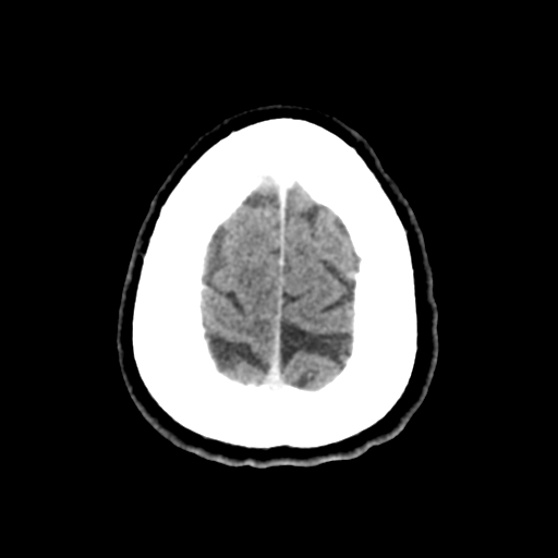 File:Cerebral metastasis to basal ganglia (Radiopaedia 81568-95412 Axial C+ delayed 51).png