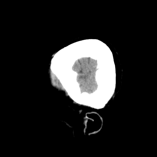 Cerebral metastasis to basal ganglia (Radiopaedia 81568-95412 E 9).png