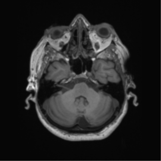 Cerebral metastasis to basal ganglia (Radiopaedia 81568-95413 Axial T1 16).png