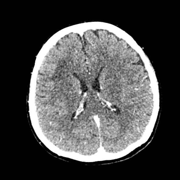 Cerebral ring enhancing lesions - cerebral metastases (Radiopaedia 44922-48818 B 171).jpg