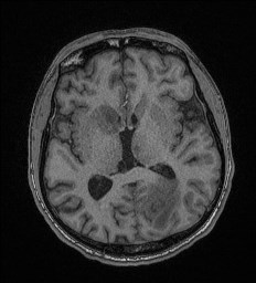 File:Cerebral toxoplasmosis (Radiopaedia 43956-47461 Axial T1 39).jpg