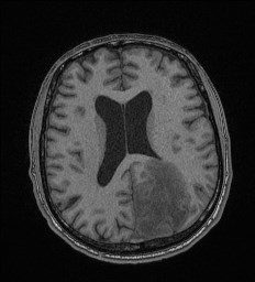 Cerebral toxoplasmosis (Radiopaedia 43956-47461 Axial T1 48).jpg