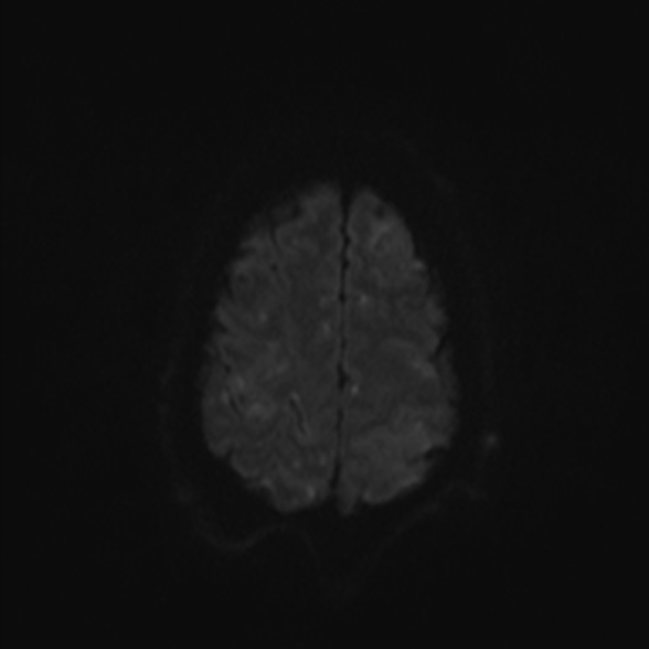 Cerebral toxoplasmosis (Radiopaedia 53993-60132 Axial DWI 50).jpg