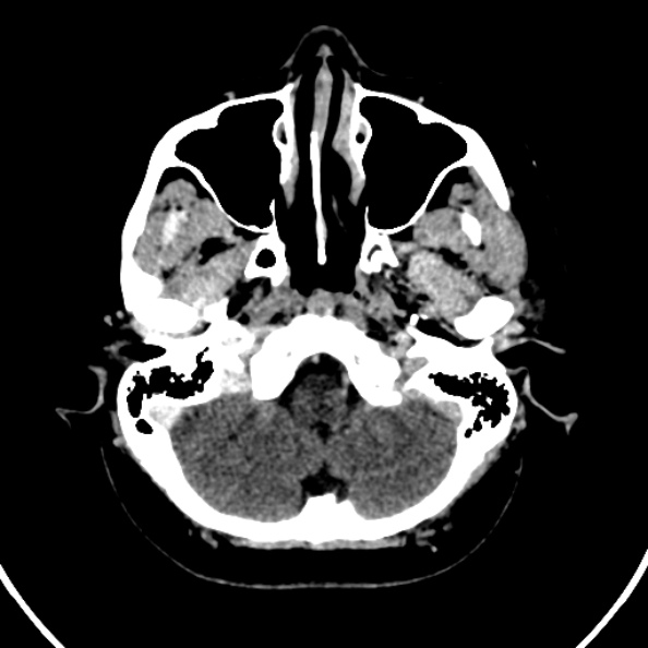 Cerebral venous hemorrhagic infarct from venous sinus thrombosis (Radiopaedia 55433-61883 Axial C+ delayed 127).jpg