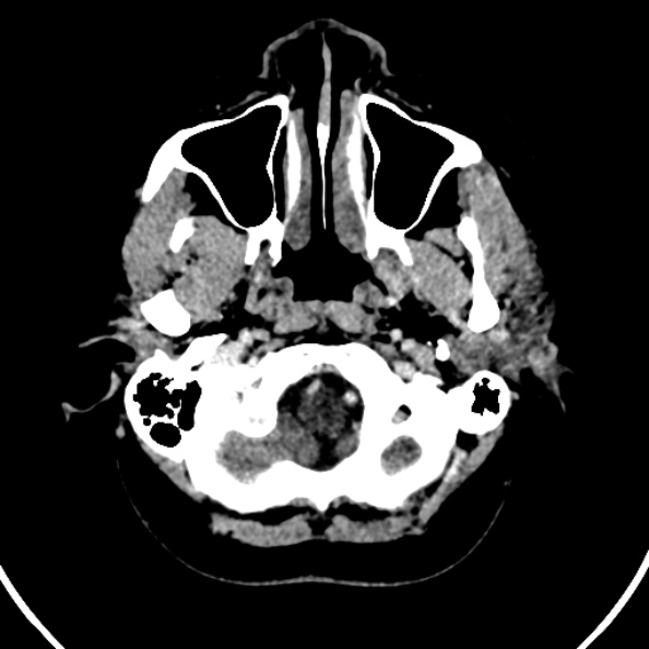 File:Cerebral venous hemorrhagic infarct from venous sinus thrombosis (Radiopaedia 55433-61883 Axial C+ delayed 136).jpg